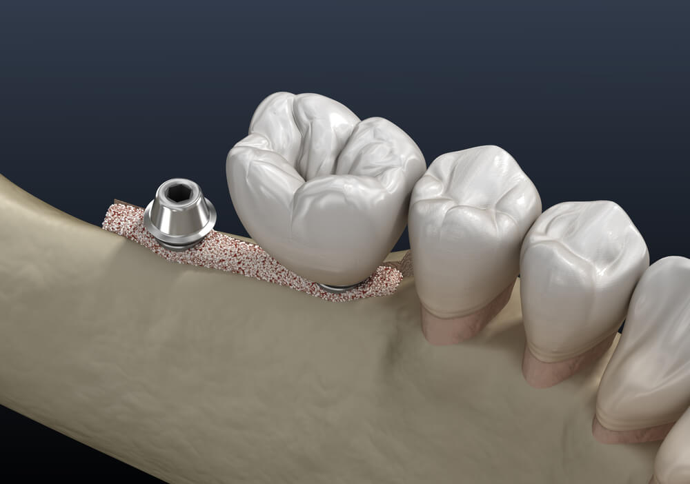 Ridge Augmentation • Carson Periodontics And Oral And Maxillofacial Surgery